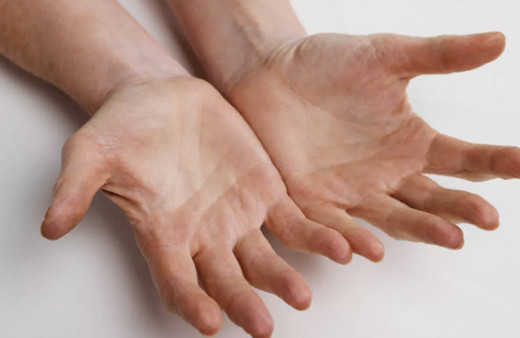 Ellerde uyuşma karıncalanma hissi neden olur hastalık habercisi mi?