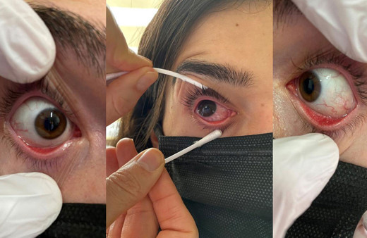 Korona bitmeden gözlerde virüs salgını başladı! Adenovirüs nedir kör eder mi?