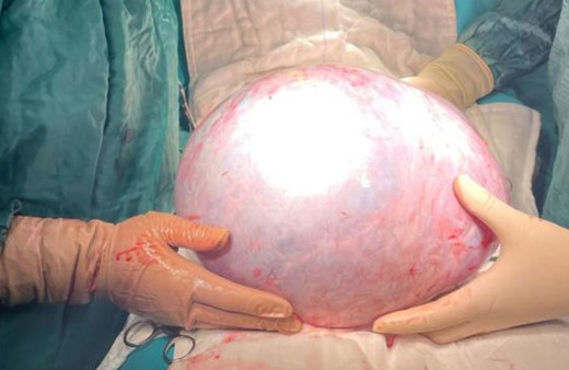 Rahatsızlığı nedeniyle hastaneye gitti hasta 64 kilo girdiği ameliyattan 55 kilo olarak çıktı