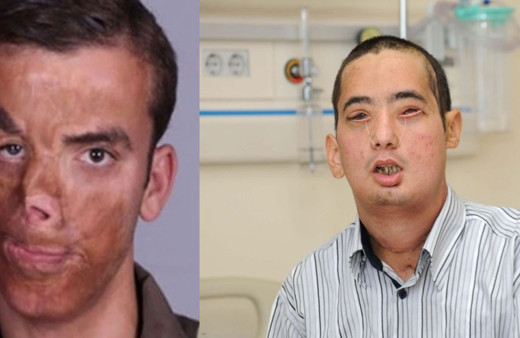 Türkiye'nin ilk yüz naklinin üzerinden 10 yıl geçti! Uğur Acar ve Turan Çolak'ın son haline bakın