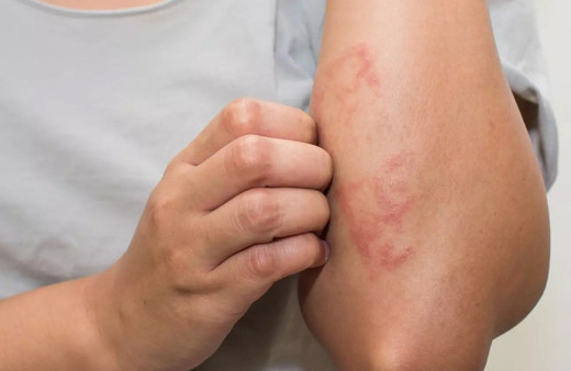 2 kişiden 1'inde çıkıyor! Salgın sonrası uyuz vakaları patladı: Uzmanlar uyardı: Uzun süre...