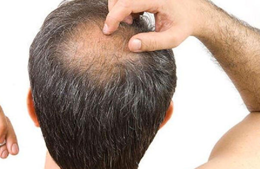 Saç dökülmesi yaşayanlara iyi haber Doç. Dr. Filiz Topaloğlu Demir yöntemi açıkladı