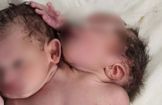 Çok nadir görülen bir olay! Doğurduğu bebeği gören anne şaşkına döndü