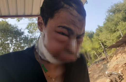 Dilinin altında çıktı çenesini kestiler! Hüseyin'den acı haber geldi