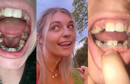 Ağrı kesici bu hale getirdi! 23 yaşındaki kadının tüm dişleri çürüyüp döküldü!