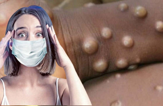 Yeni Kabus! Maymun Çiçeği hastalığı paniği nasıl bulaşıyor, tedavisi var mı? ABD ve İngiltere'ye sıçradı