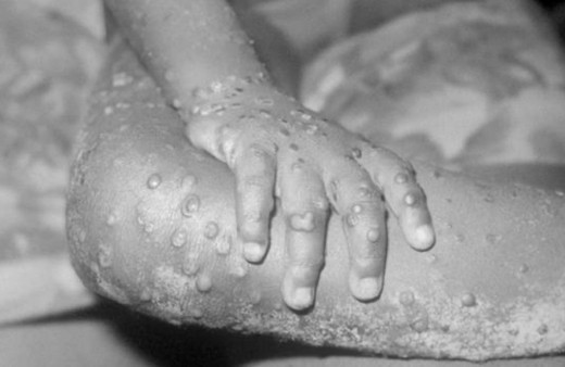 Maymun çiçeği bir ülkeye daha sıçradı kabus hızla yayılıyor