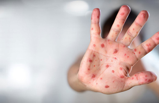 "Maymun Çiçeği hastalığı Türkiye'de" iddiası! DSÖ'den korkutan uyarı cinsel yolla bulaşıyor