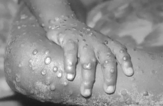 Ülkede maymun çiçeği paniği! İlk kez görüldü