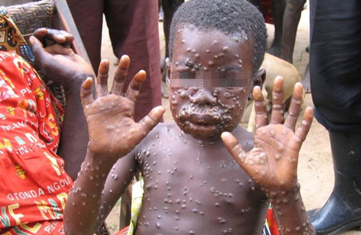 TTB'den "maymun çiçeği hastalığı" açıklaması