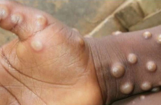 Maymun çiçeği hakkında bilinmeyenler! Prof. Akalın tek tek açıkladı