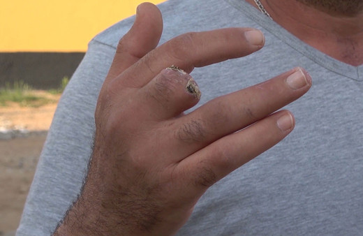 Kırıkkale'de çiftliğini koruması için aldı canını zor kurtardı orta parmağını koparttı