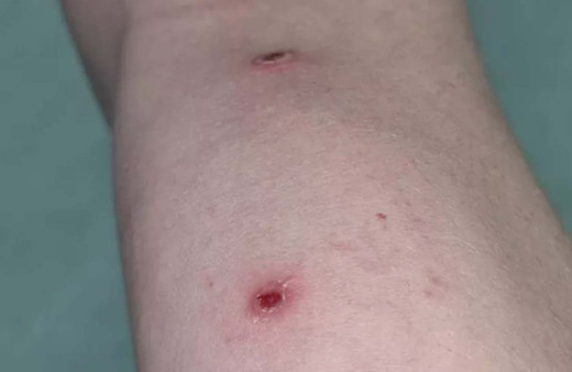 İlk maymun çiçeği hastası yaşadıklarını anlattı: 60'dan fazla yara saydım