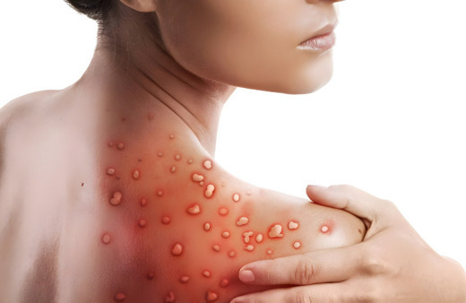 Maymun çiçeği cinsel hastalık mı? DSÖ'den açıklama geldi