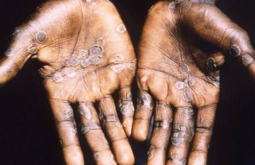 Maymun çiçeği virüsü yayılmaya devam ediyor: Bir ülkede daha görüldü