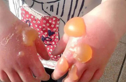 Parkı bahçeyi sardı dokunan çocuğun eli yandı göze değerse kör ediyor!