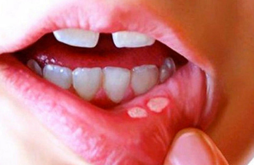 Ağız yarası oluşumunu azaltmak için ne yapmalı? Uzman isimden öneriler