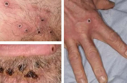 Maymun çiçeği virüsünde beklenmedik gelişme! Uzmanlar uyardı