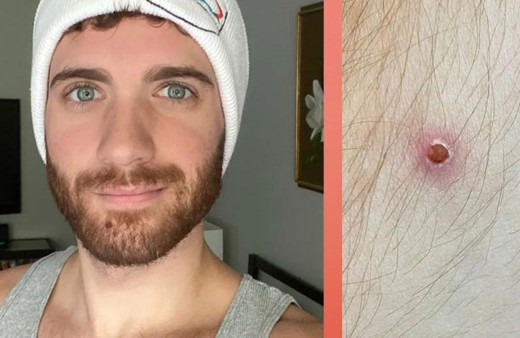 Türkiye’de de görülen maymun çiçeği hastalığına yakalanan kişi konuştu! Semptomlarına bakın