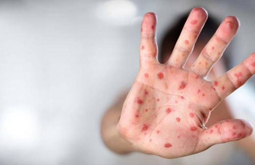 Rusya'da ilk maymun çiçeği virüsü vakası