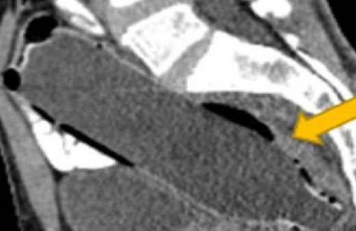 Makatına şişe yoktu Eşi sayesinde şişeden kurtuldu