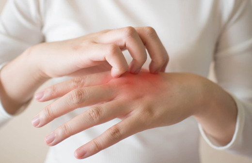 Egzaması olan kişiler dikkat! İşte doğal yoldan egzamadan kurtulma yöntemleri