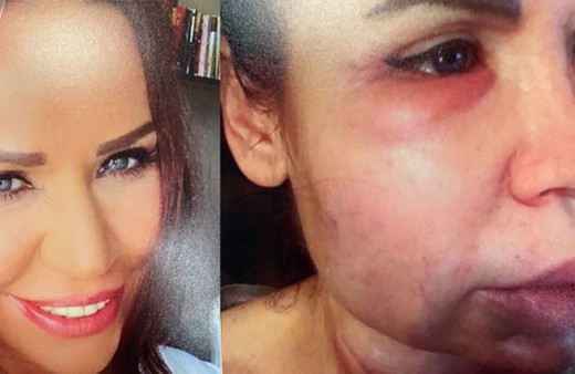 İstanbul'da estetik faciası! Lise mezunu doktor (!) tanınmaz hale getirdi