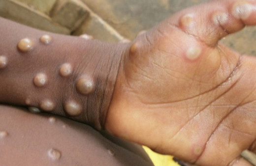 Maymun Çiçeği virüsü bir ülkeye daha sıçradı! İlk vaka görüldü aşılama başladı