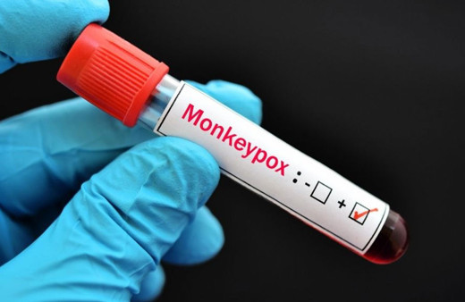 Sağlık Bakanlığı yayınladı maymun çiçeği belirtileri ve bulaşma yolları rehberi