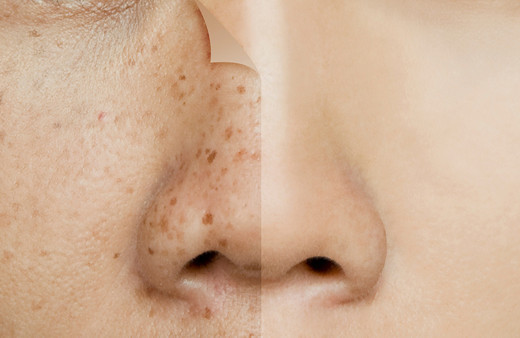 Vücuttaki güneş lekelerinden kurtulmanız için 12 mucizevi yöntem!