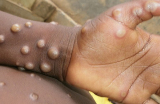 Maymun çiçeği virüsü yayılıyor: Almanya'da 4 yaşındaki çocuğa bulaştı