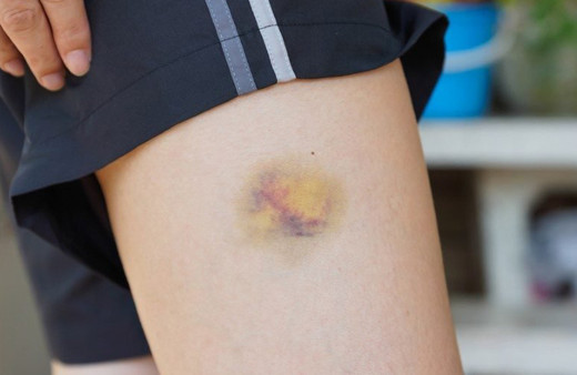 Vücudumuzdaki morluklardan doğal yollarla kurtulabilirsiniz