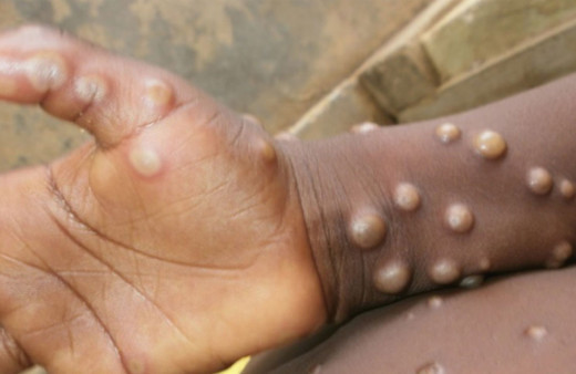 Maymun Çiçeği kabusu büyüyor: Bir ülkeye daha sıçradı!