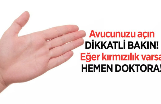 Avucunuzu açın ve dikkatli bakın! Kızarıklık varsa hiç durmayın hemen doktora gidin!