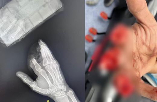 3 parmağını kaybetti ben bittim derken 12 saat sonra parmaklarını buldu