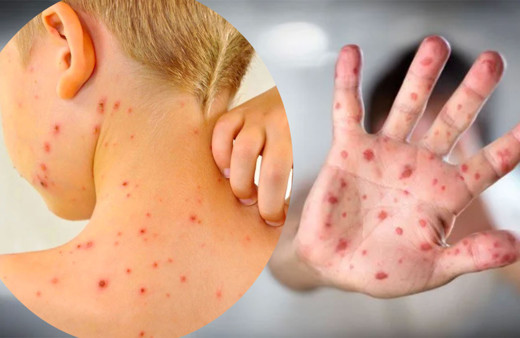 Yeni salgın kabusu! 'Domates Gribi' çocukları vuruyor ve çok hızlı bulaşıyor belirtisi neler tedavisi var mı?