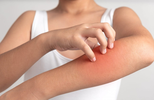 Şiddetli kaşıntınız varsa ve bir türlü geçmiyorsa uyuz olabilirsiniz! İşte belirtileri