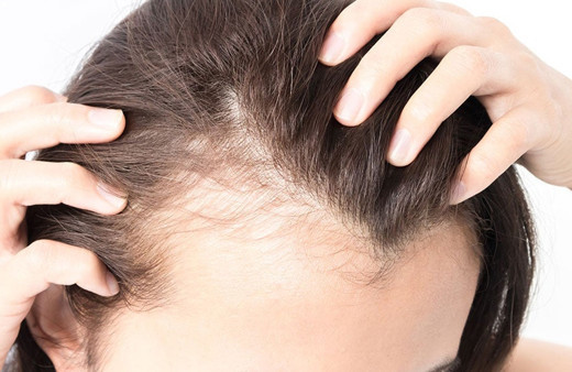 Beyaz saç teli koparılırsa daha çok çıkar mı? Uzman isim noktayı koydu