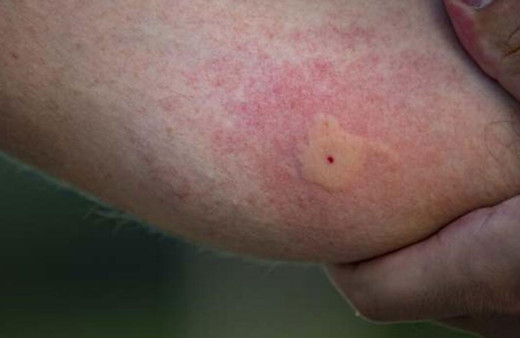 Dünya diken üstünde Komşu'da 11 kişiyi öldürdü! Uzmanı semptomlarını açıkladı