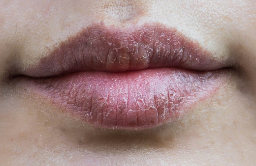 Dudak kuruluğu yaşıyorsanız bu yöntemleri mutlaka deneyin