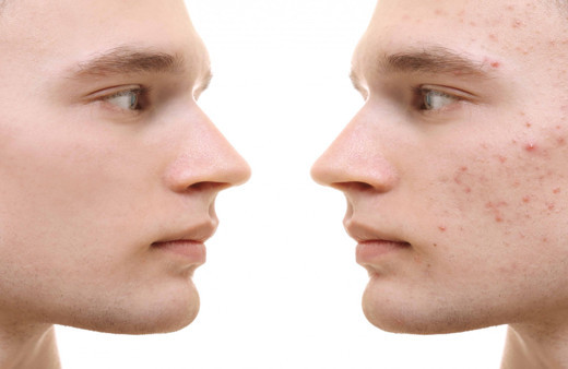 Sivilceleri anında kurutan bu yöntemleri deneyince gözlerinize inanamayacaksınız