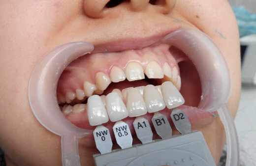 Dişim renk değiştiriyor fırçalıyorum ama düzelmiyor diyorsanız bu hataya düşmeyin!