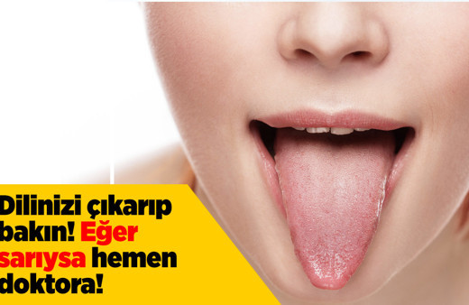 Dil rengine göre hastalık belirtileri neler rengi sarıysa hemen doktora!