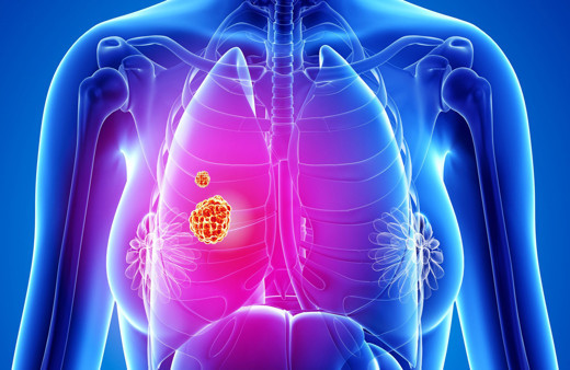 Akciğer kanserini erken teşhis etmenin yolunu deneyin! Bu parmak testiyle hayatınız kurtulabilir