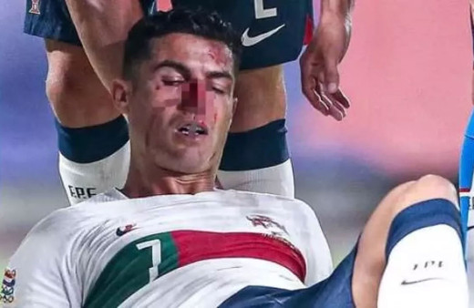 Kaleciyle çarpıştı! Cristiano Ronaldo kanlar içinde kaldı