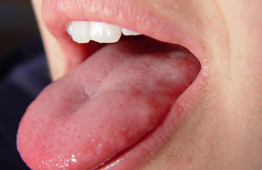 Eğer dilinizde beyazlama varsa hemen doktora gidin! Bu hastalığa sahip olabilirsiniz...