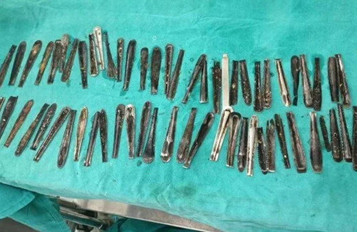 Karın ağrısı şikayetiyle hastaneye giden adamın midesinden 63 kaşık çıktı