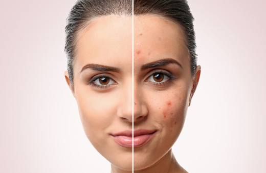 Bu yöntemler ile yüzünüzdeki sivilcelerden aynında kurtulabilirsiniz!