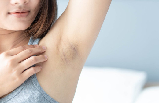 Koltuk altı kararması kabusunuz olmasın anında geçiren doğal çözümler burada!