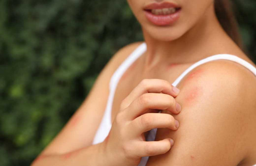 Sivrisinek yüzünden cildinizi tahriş etmeyin işte kaşıntıyı geçirecek doğal yöntemler!